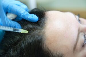 application of capillary mesotherapy for hair loss